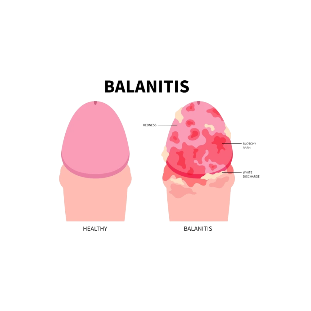 Balanitis