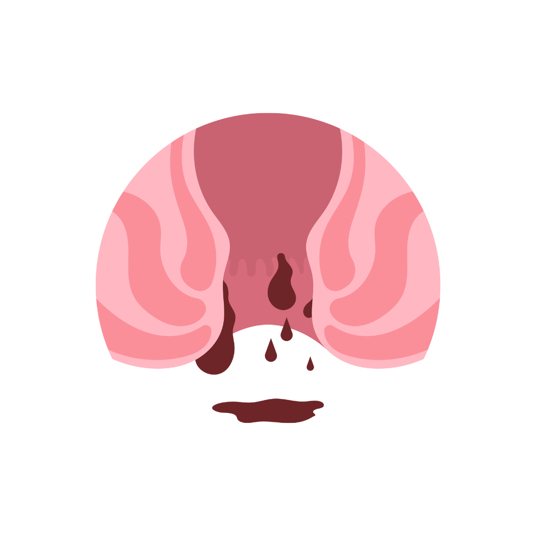 Fissure