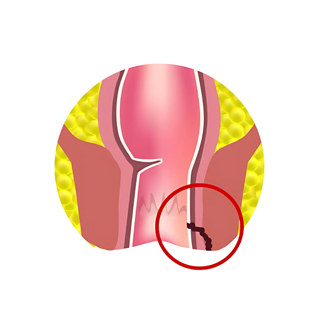 Fistula
