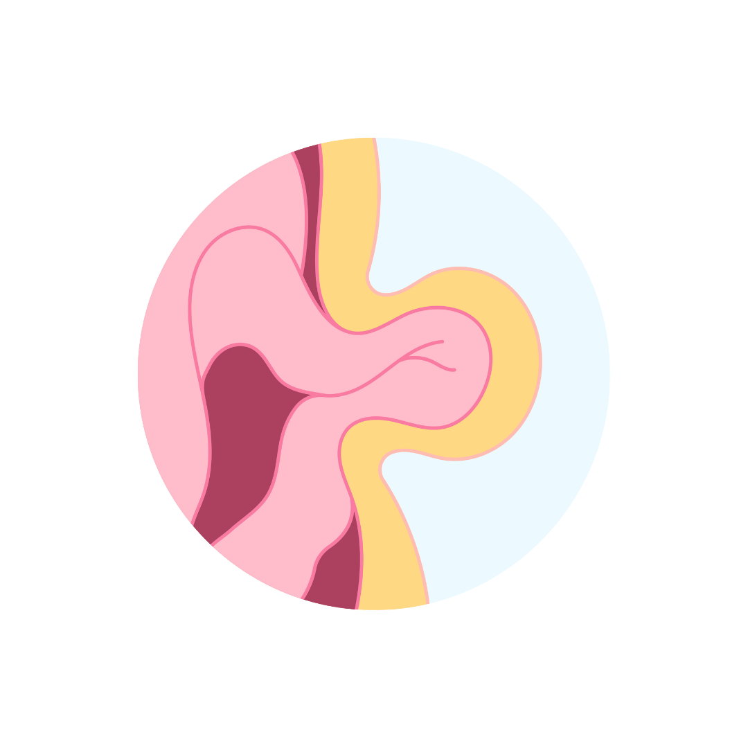 Hernia