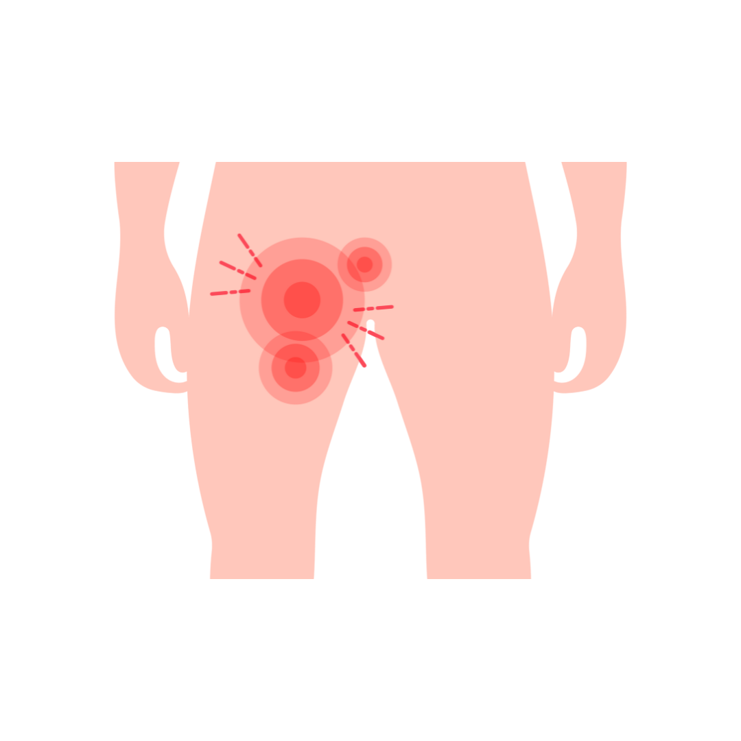 Hydrocele