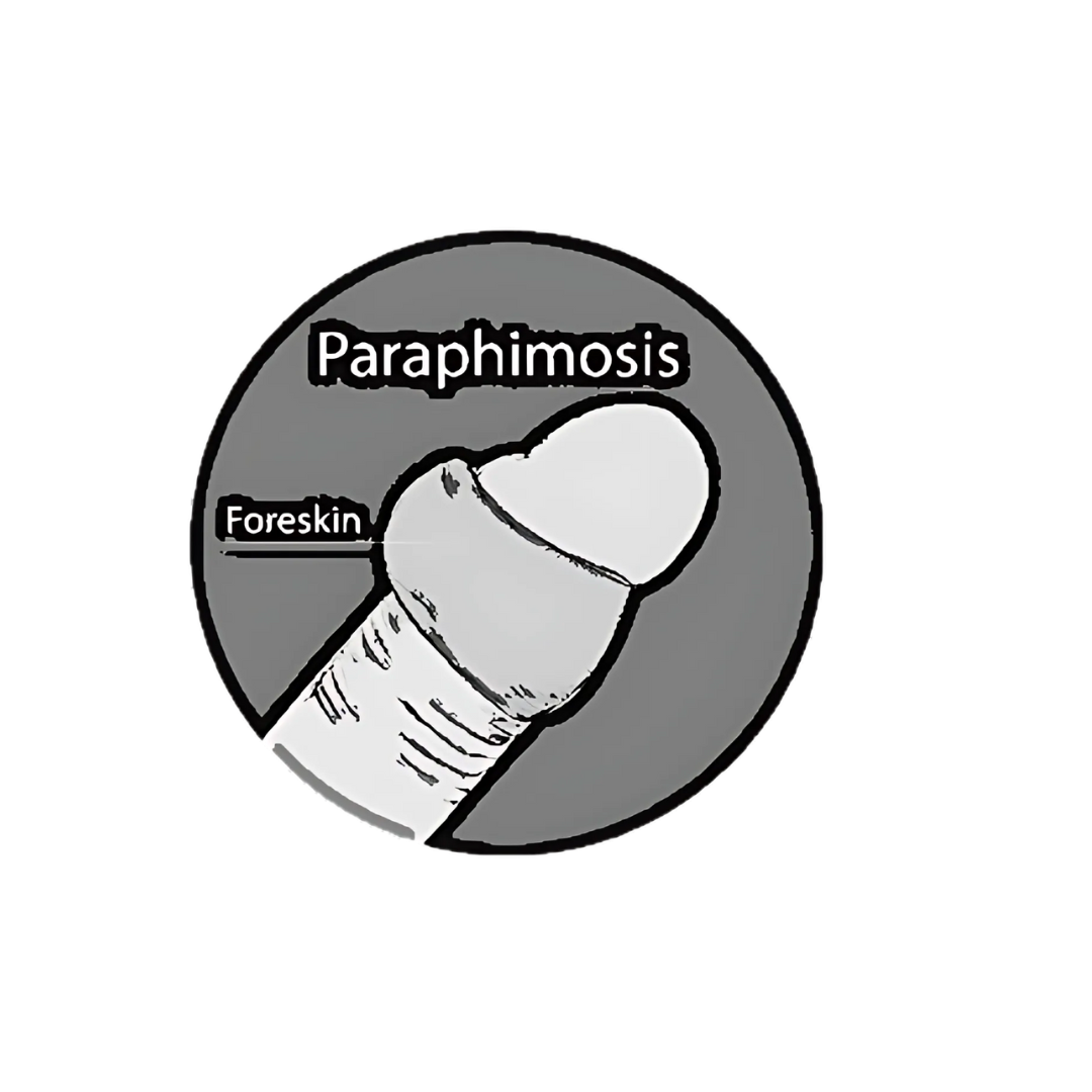 Paraphimosis